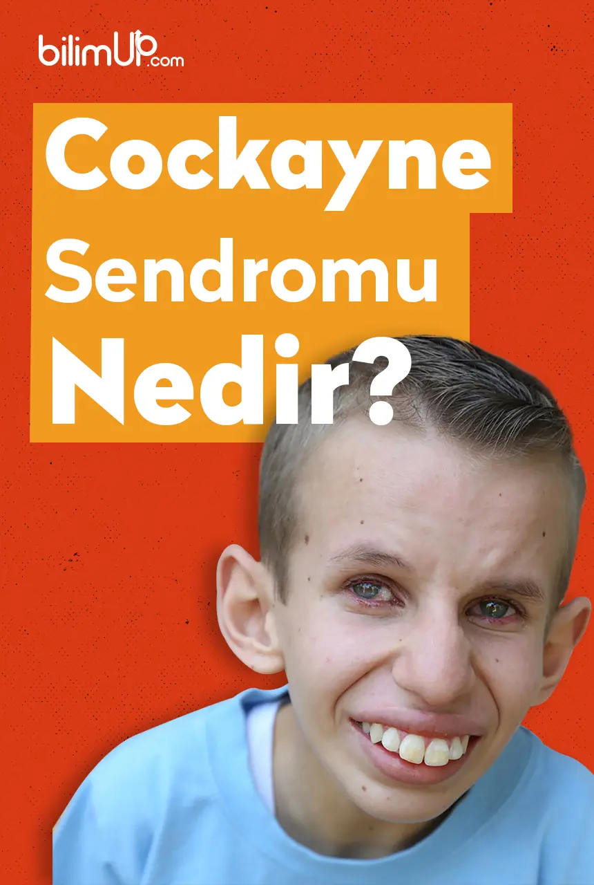 Cockayne Sendromu Nedir?