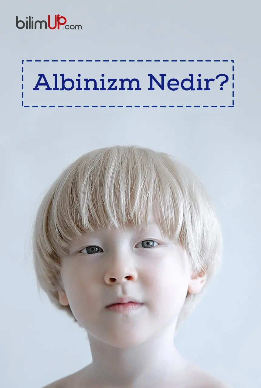 Albinizm Nedir?