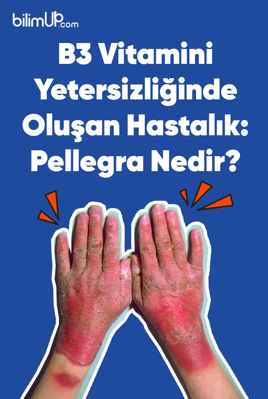 B3 Vitamini Yetersizliğinde Oluşan Hastalık: Pellegra Nedir?