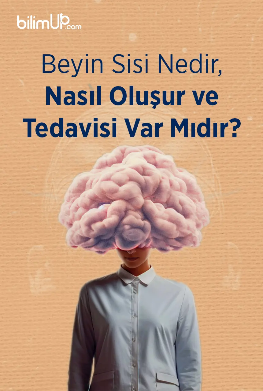 Beyin Sisi Nedir, Nasıl Oluşur ve Tedavisi Var Mıdır?