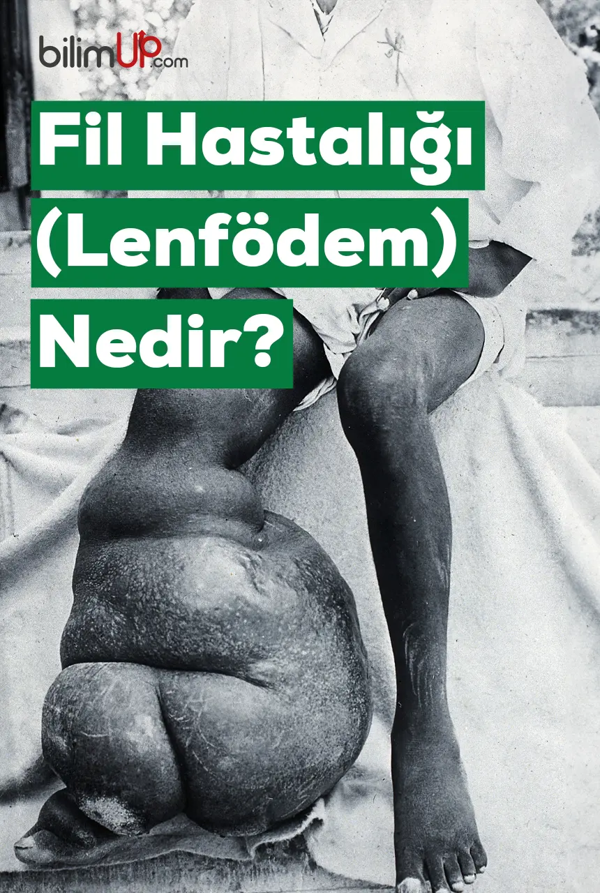 Fil Hastalığı (Lenfödem) Nedir?