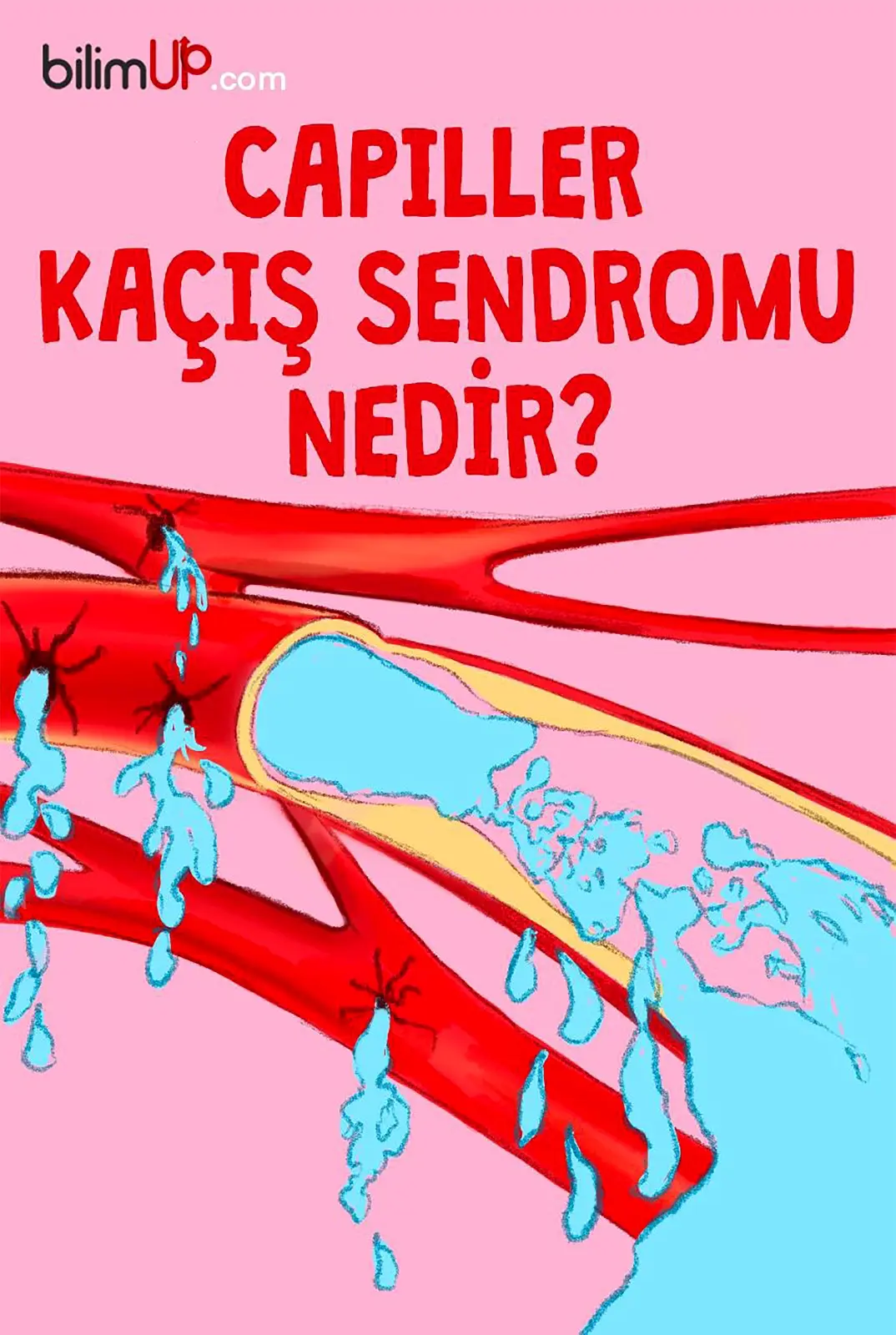 Kapiller Kaçış Sendromu Nedir?