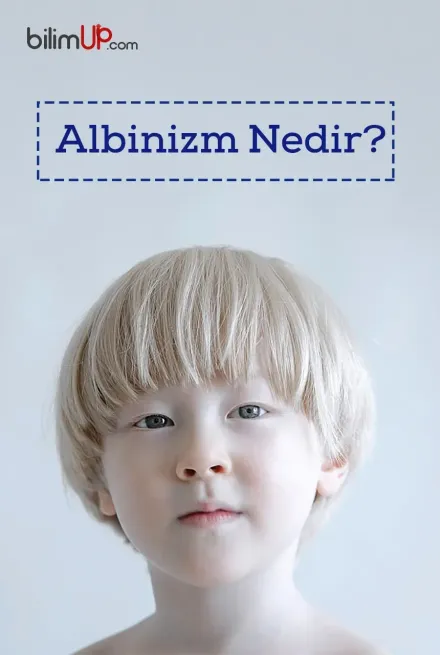 Albinizm Nedir?