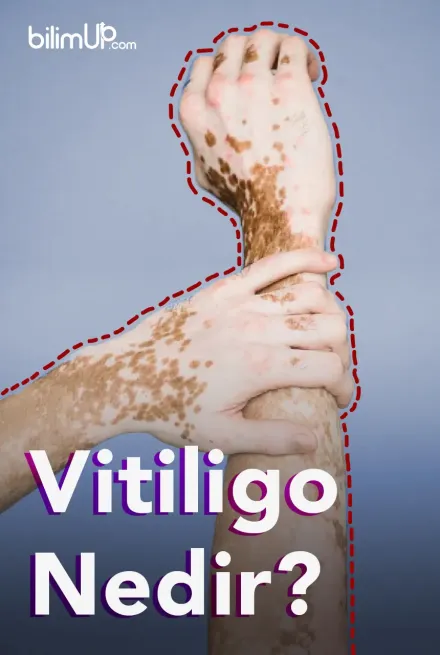 Vitiligo nedir?