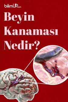 Beyin Kanaması Nedir?