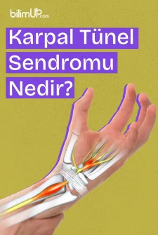 Karpal Tünel Sendromu Nedir?
