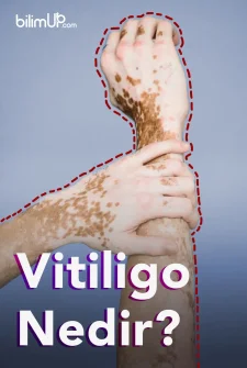 Vitiligo nedir?