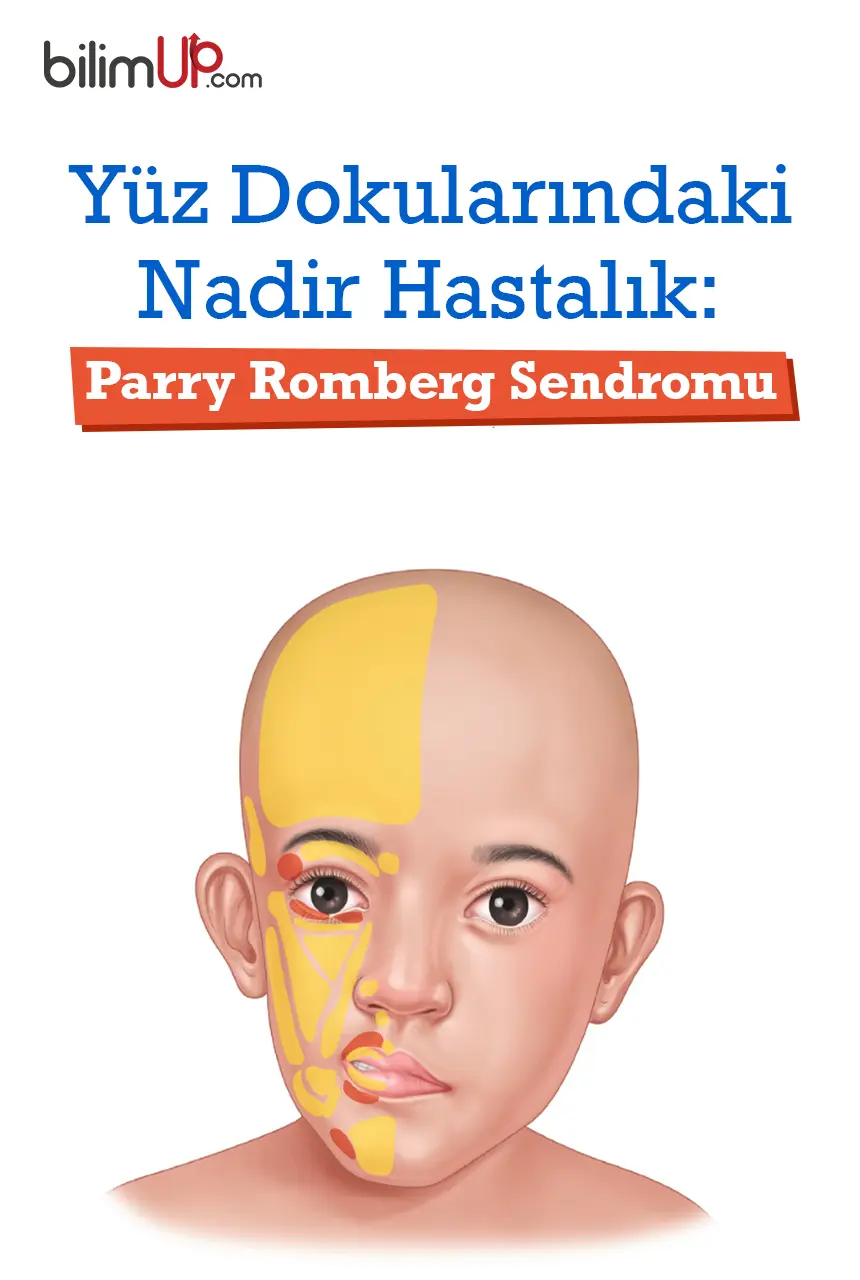 Yüz Dokularındaki Nadir Hastalık: Parry Romberg Sendromu